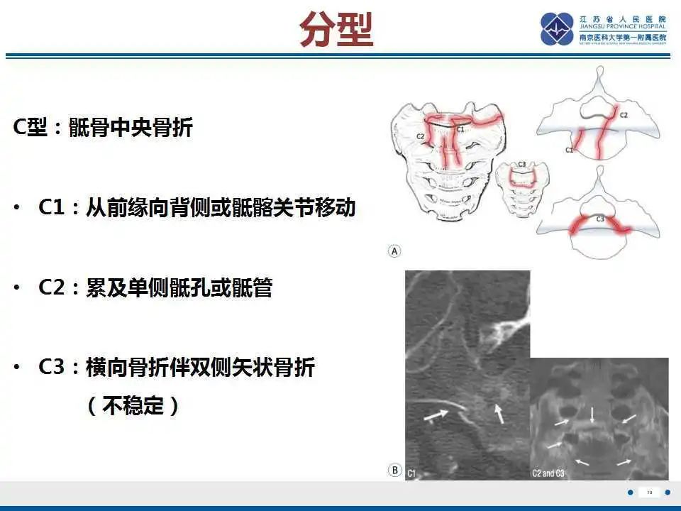 影像PPT - 【PPT】骶骨机能不全骨折-20