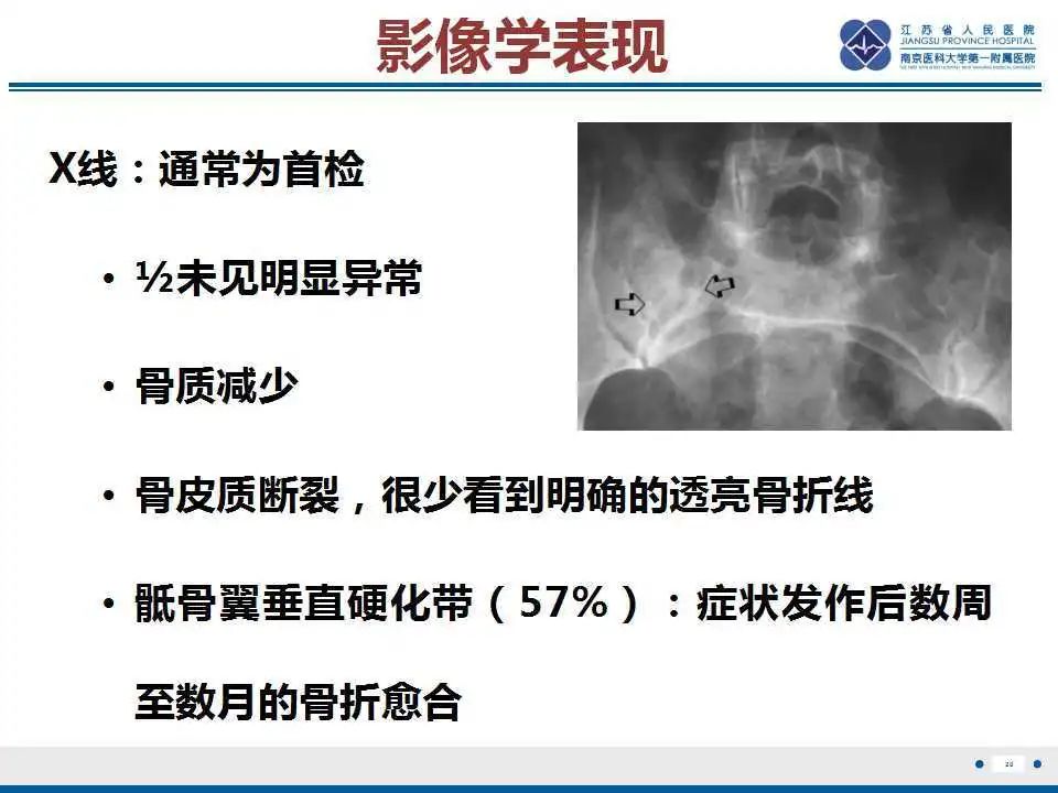 影像PPT - 【PPT】骶骨机能不全骨折-21