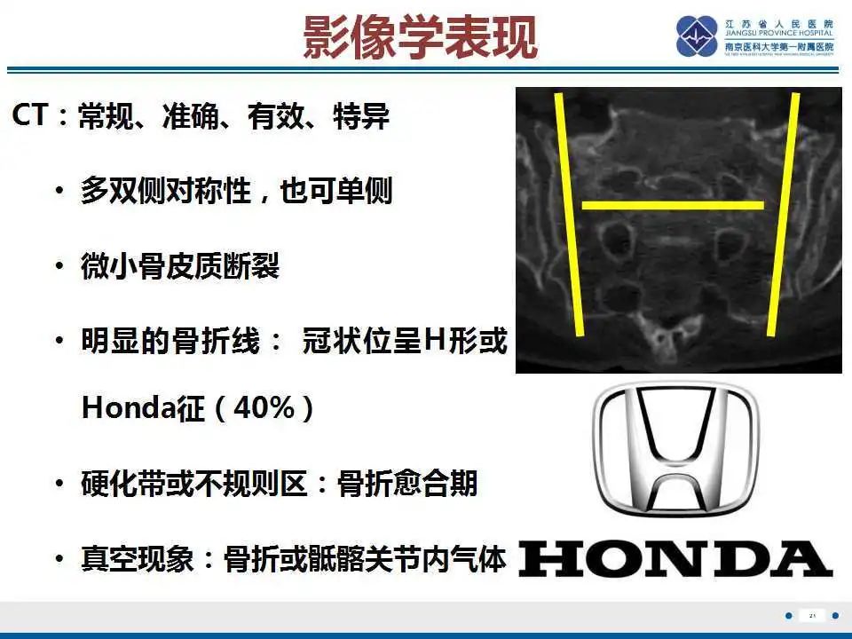 影像PPT - 【PPT】骶骨机能不全骨折-22