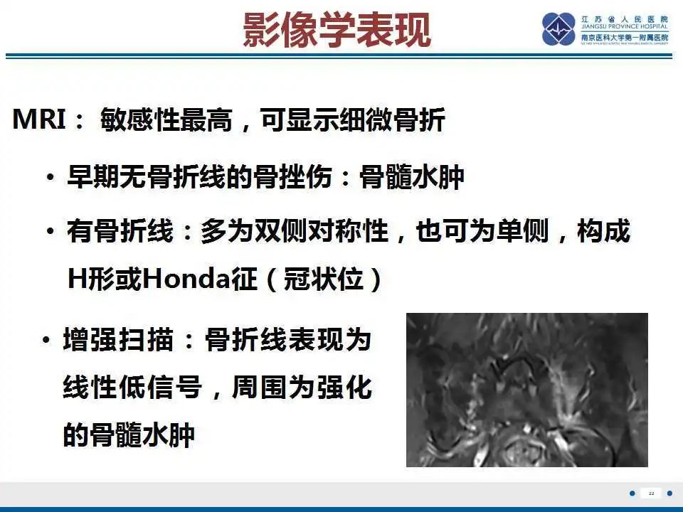 影像PPT - 【PPT】骶骨机能不全骨折-23