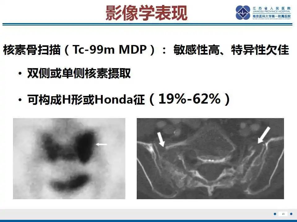 影像PPT - 【PPT】骶骨机能不全骨折-24