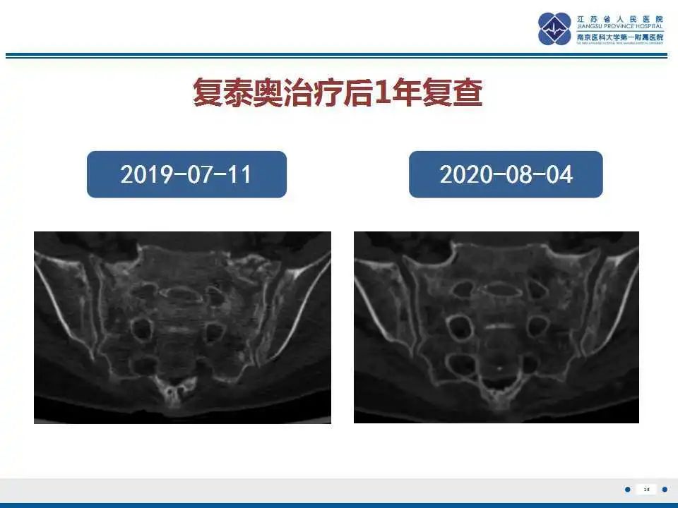 影像PPT - 【PPT】骶骨机能不全骨折-26