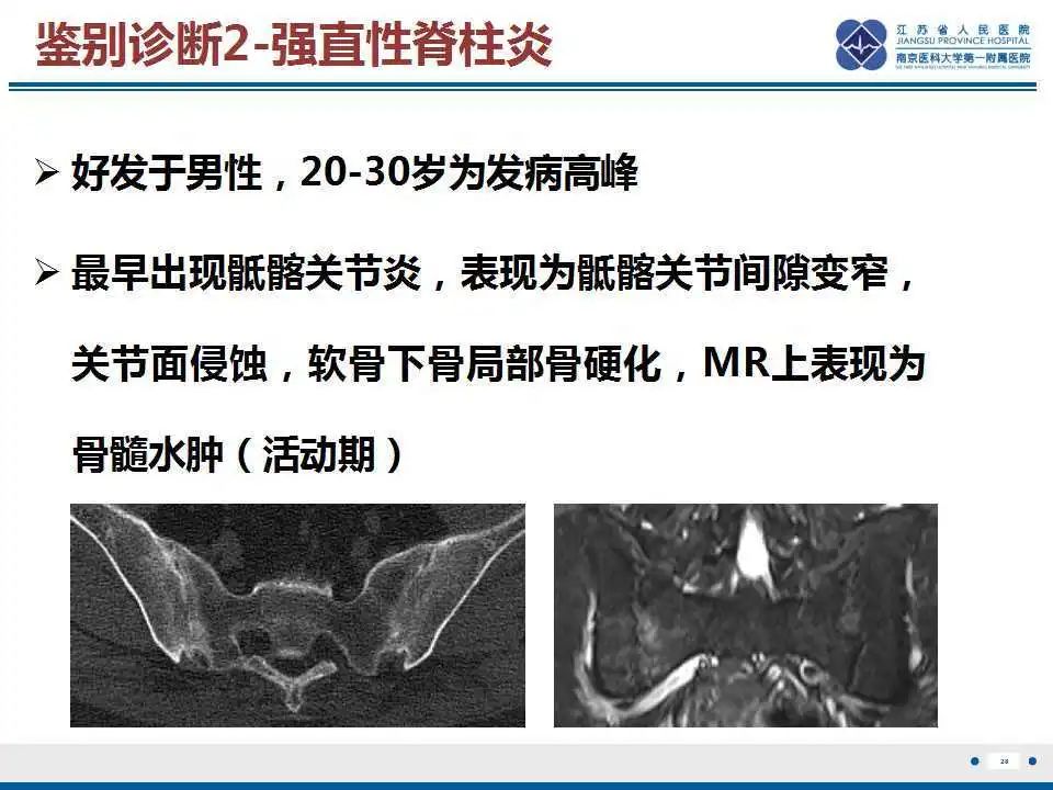 影像PPT - 【PPT】骶骨机能不全骨折-29
