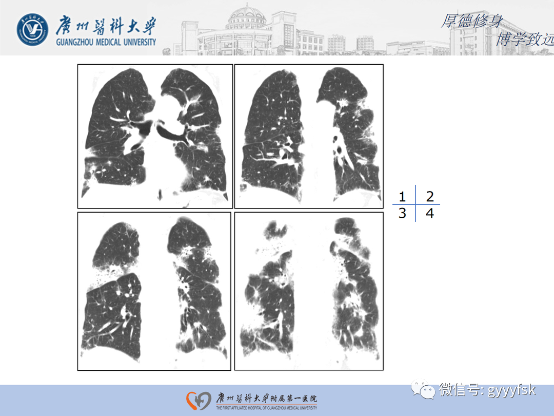 影像PPT - 【病例】隐源性机化性肺炎1例CT影像-5