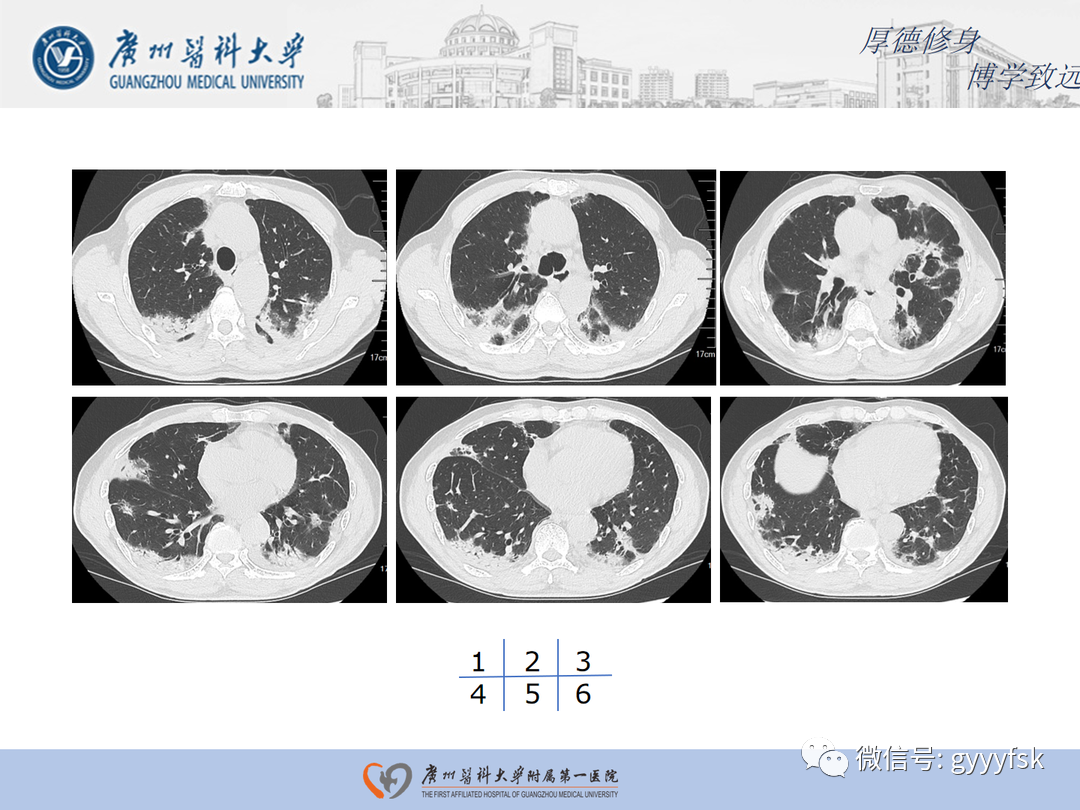 影像PPT - 【病例】隐源性机化性肺炎1例CT影像-4