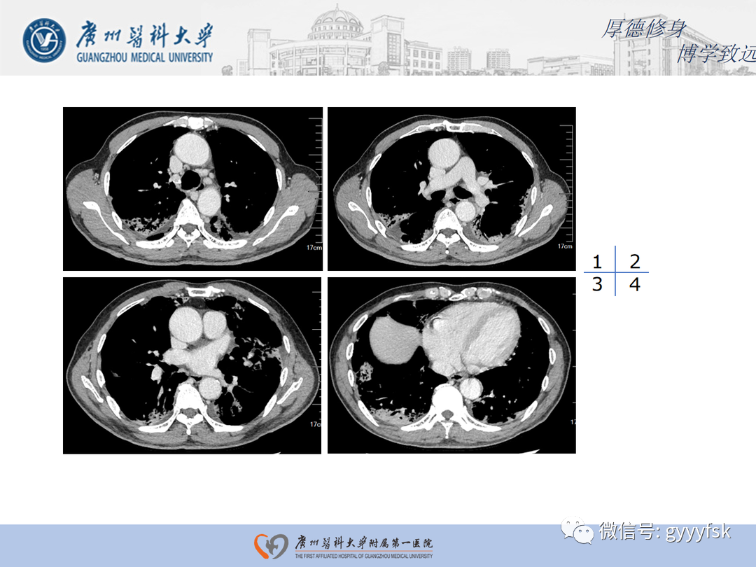 影像PPT - 【病例】隐源性机化性肺炎1例CT影像-6