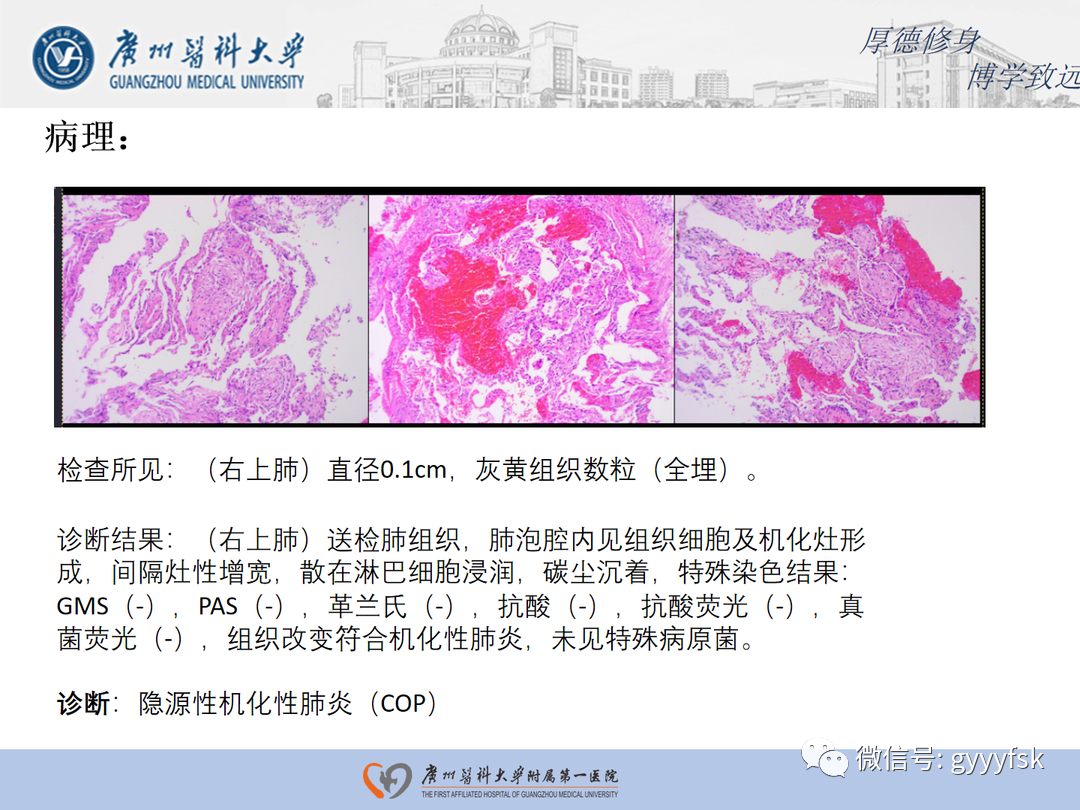 影像PPT - 【病例】隐源性机化性肺炎1例CT影像-8