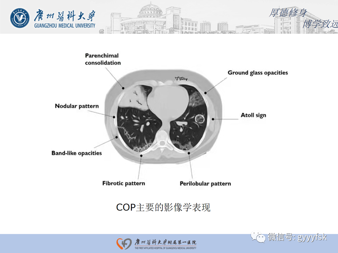 影像PPT - 【病例】隐源性机化性肺炎1例CT影像-12