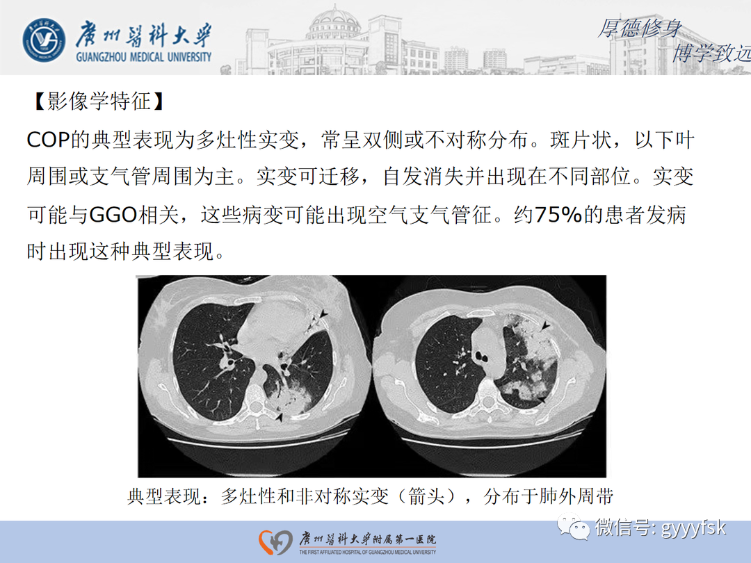 影像PPT - 【病例】隐源性机化性肺炎1例CT影像-13