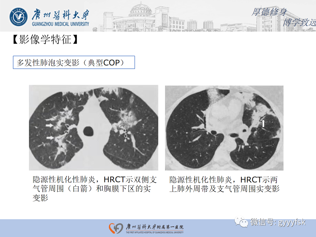 影像PPT - 【病例】隐源性机化性肺炎1例CT影像-15