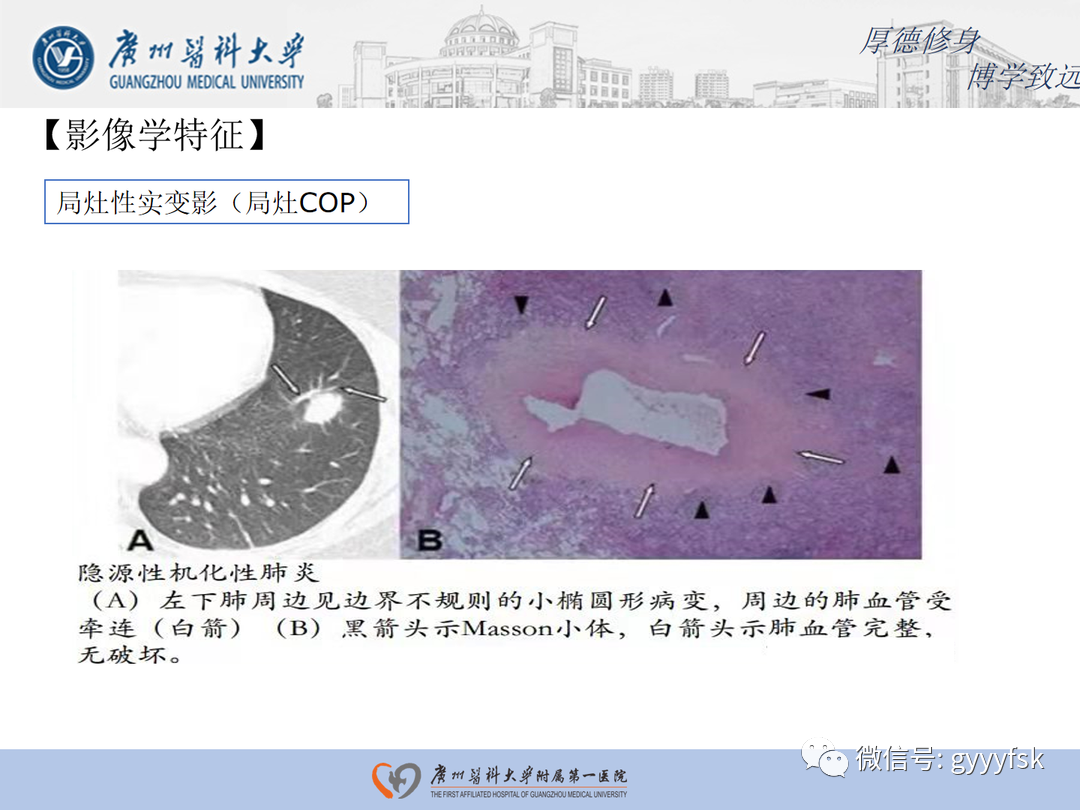 影像PPT - 【病例】隐源性机化性肺炎1例CT影像-16