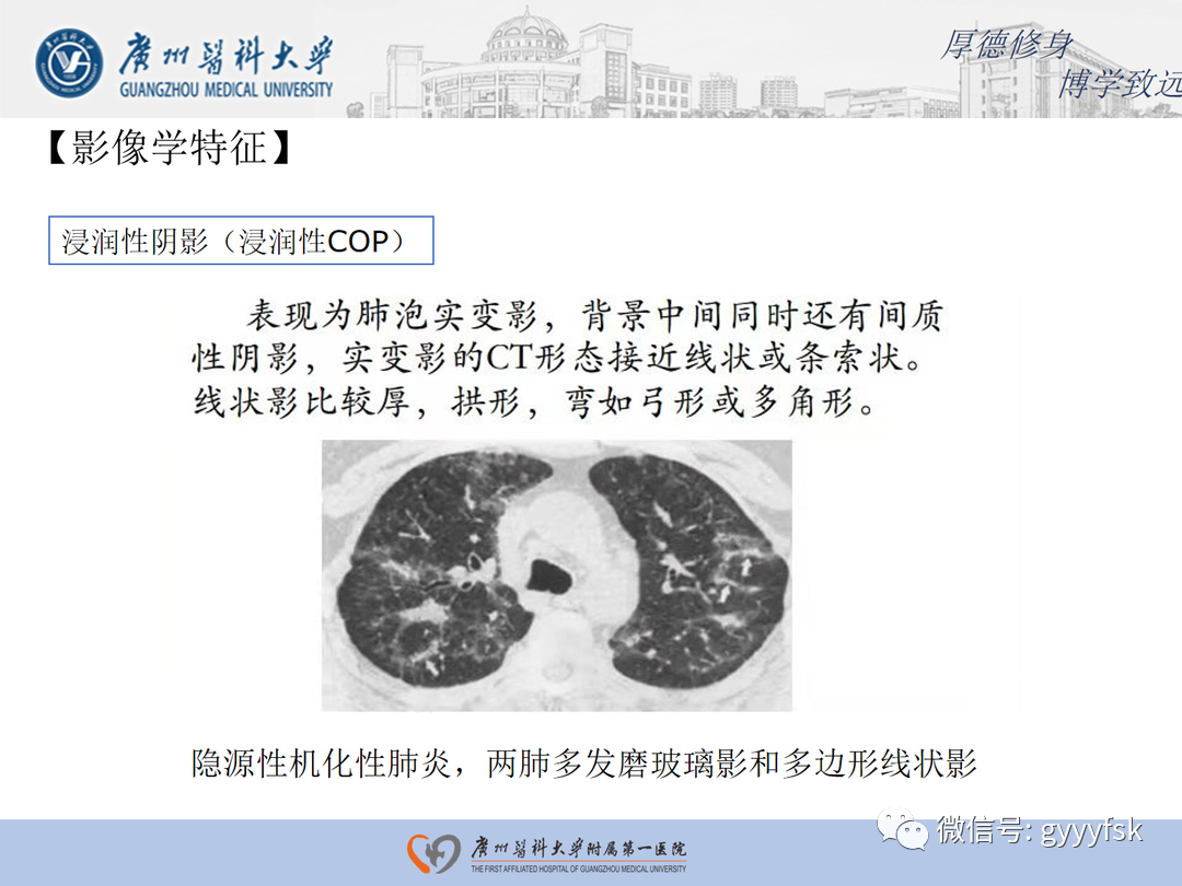 影像PPT - 【病例】隐源性机化性肺炎1例CT影像-17