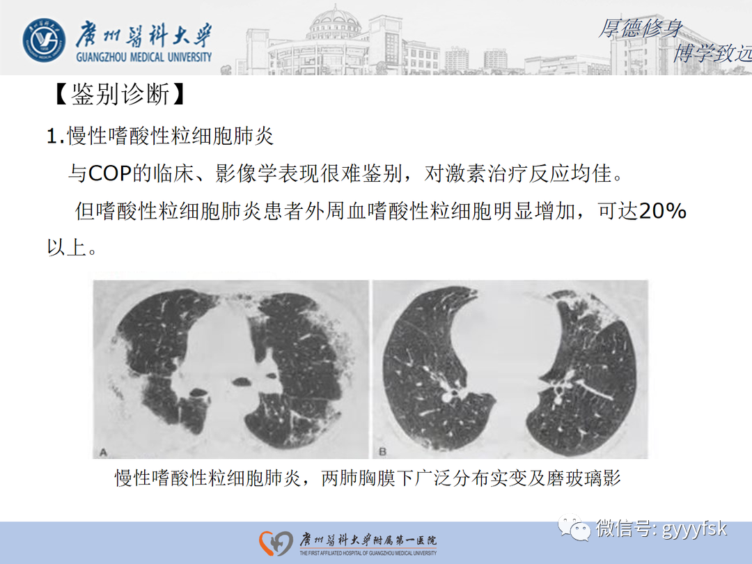 影像PPT - 【病例】隐源性机化性肺炎1例CT影像-18