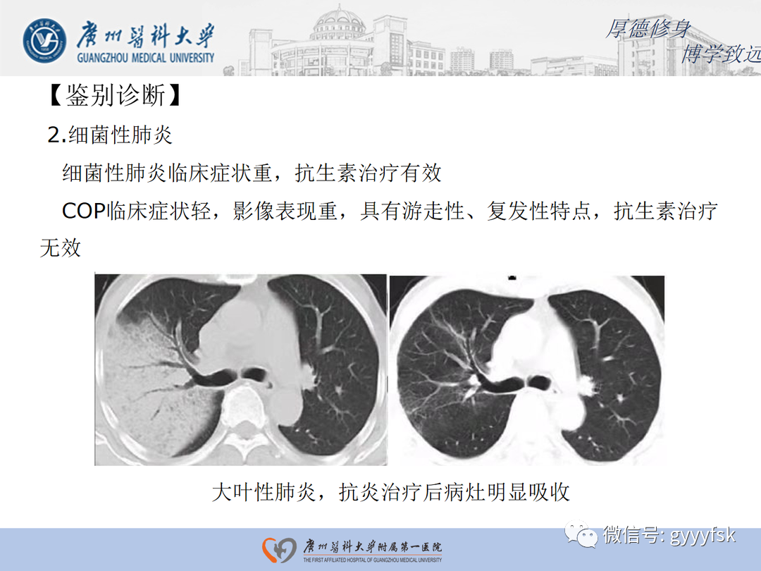 影像PPT - 【病例】隐源性机化性肺炎1例CT影像-19