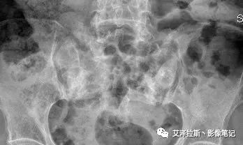 影像PPT - 【病例】骶骨功能不全骨折/衰竭骨折2例X线CT影像-1 影像PPT - 【病例】骶骨功能不全骨折/衰竭骨折2例X线CT影像-1