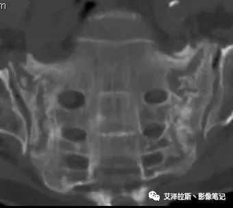 影像PPT - 【病例】骶骨功能不全骨折/衰竭骨折2例X线CT影像-2 影像PPT - 【病例】骶骨功能不全骨折/衰竭骨折2例X线CT影像-2