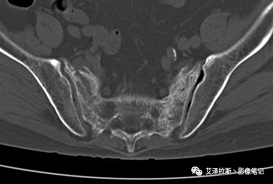 影像PPT - 【病例】骶骨功能不全骨折/衰竭骨折2例X线CT影像-3 影像PPT - 【病例】骶骨功能不全骨折/衰竭骨折2例X线CT影像-3