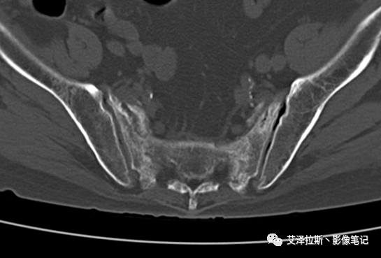 影像PPT - 【病例】骶骨功能不全骨折/衰竭骨折2例X线CT影像-4 影像PPT - 【病例】骶骨功能不全骨折/衰竭骨折2例X线CT影像-4