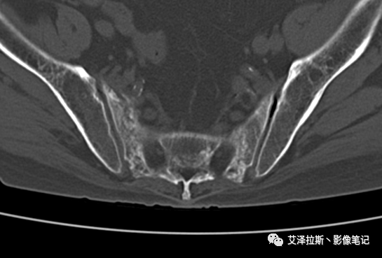 影像PPT - 【病例】骶骨功能不全骨折/衰竭骨折2例X线CT影像-5 影像PPT - 【病例】骶骨功能不全骨折/衰竭骨折2例X线CT影像-5