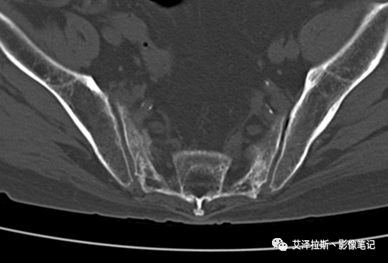 影像PPT - 【病例】骶骨功能不全骨折/衰竭骨折2例X线CT影像-6 影像PPT - 【病例】骶骨功能不全骨折/衰竭骨折2例X线CT影像-6