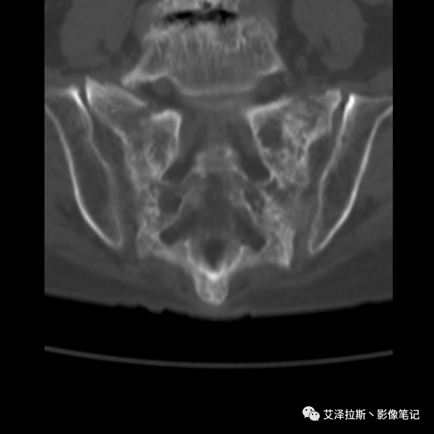 影像PPT - 【病例】骶骨功能不全骨折/衰竭骨折2例X线CT影像-7 影像PPT - 【病例】骶骨功能不全骨折/衰竭骨折2例X线CT影像-7