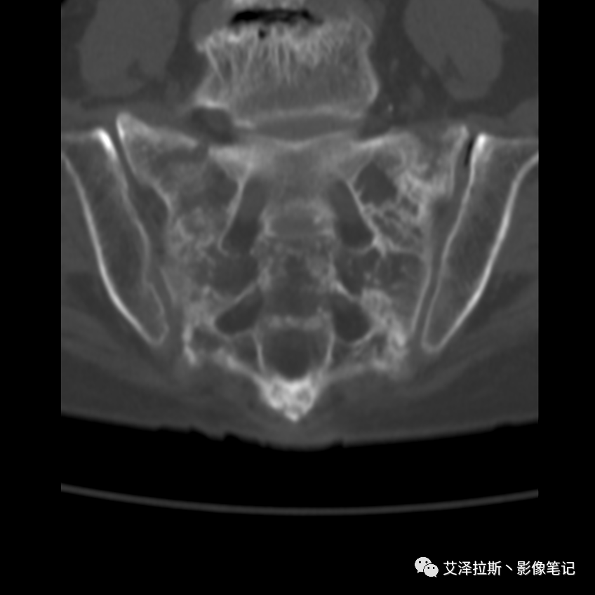 影像PPT - 【病例】骶骨功能不全骨折/衰竭骨折2例X线CT影像-8 影像PPT - 【病例】骶骨功能不全骨折/衰竭骨折2例X线CT影像-8