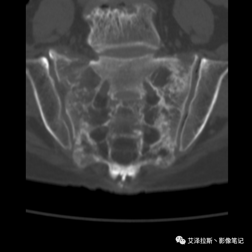 影像PPT - 【病例】骶骨功能不全骨折/衰竭骨折2例X线CT影像-9 影像PPT - 【病例】骶骨功能不全骨折/衰竭骨折2例X线CT影像-9