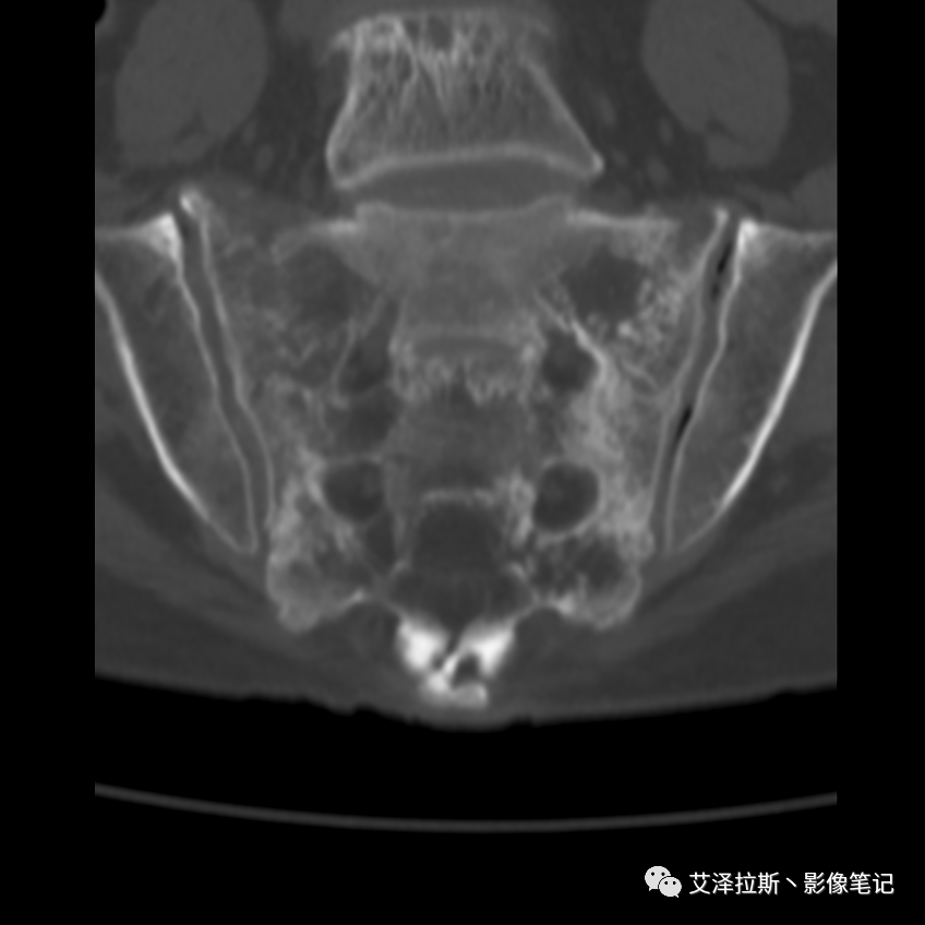 影像PPT - 【病例】骶骨功能不全骨折/衰竭骨折2例X线CT影像-10 影像PPT - 【病例】骶骨功能不全骨折/衰竭骨折2例X线CT影像-10