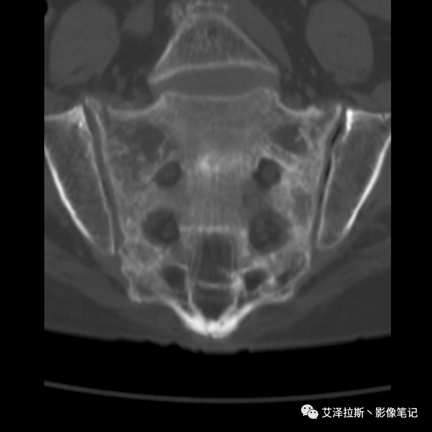 影像PPT - 【病例】骶骨功能不全骨折/衰竭骨折2例X线CT影像-12 影像PPT - 【病例】骶骨功能不全骨折/衰竭骨折2例X线CT影像-12