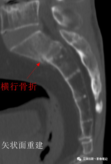 影像PPT - 【病例】骶骨功能不全骨折/衰竭骨折2例X线CT影像-13 影像PPT - 【病例】骶骨功能不全骨折/衰竭骨折2例X线CT影像-13