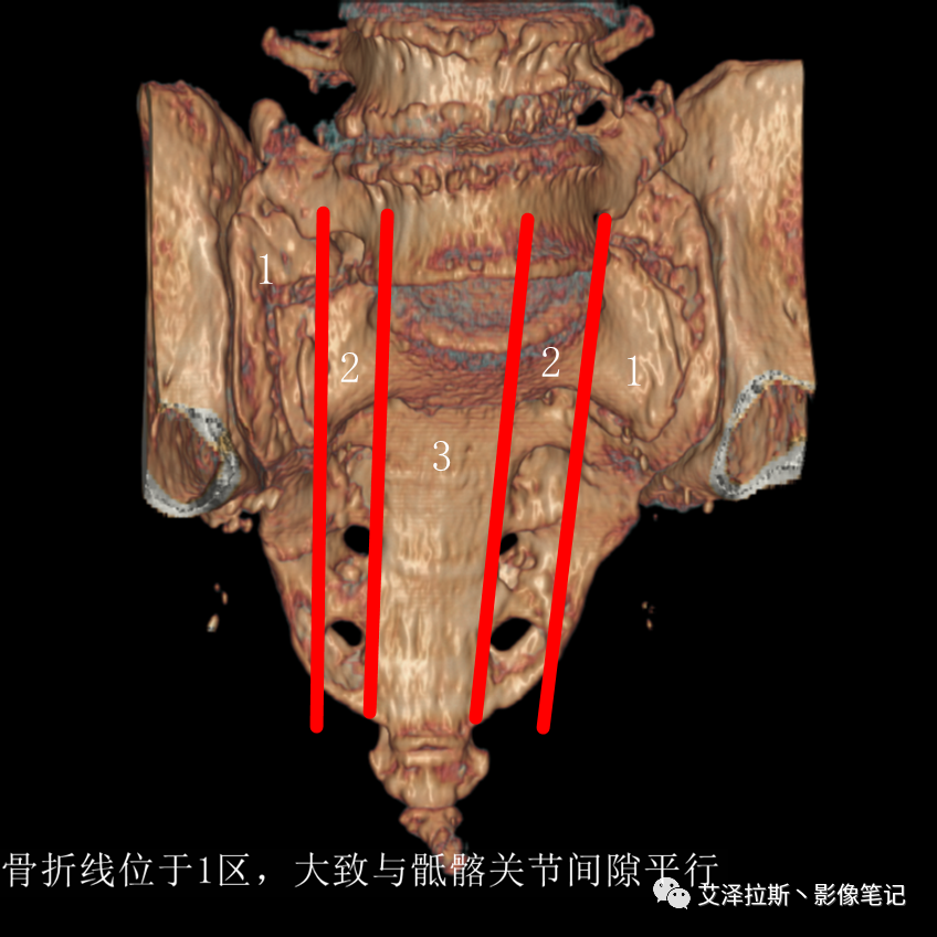 影像PPT - 【病例】骶骨功能不全骨折/衰竭骨折2例X线CT影像-15 影像PPT - 【病例】骶骨功能不全骨折/衰竭骨折2例X线CT影像-15