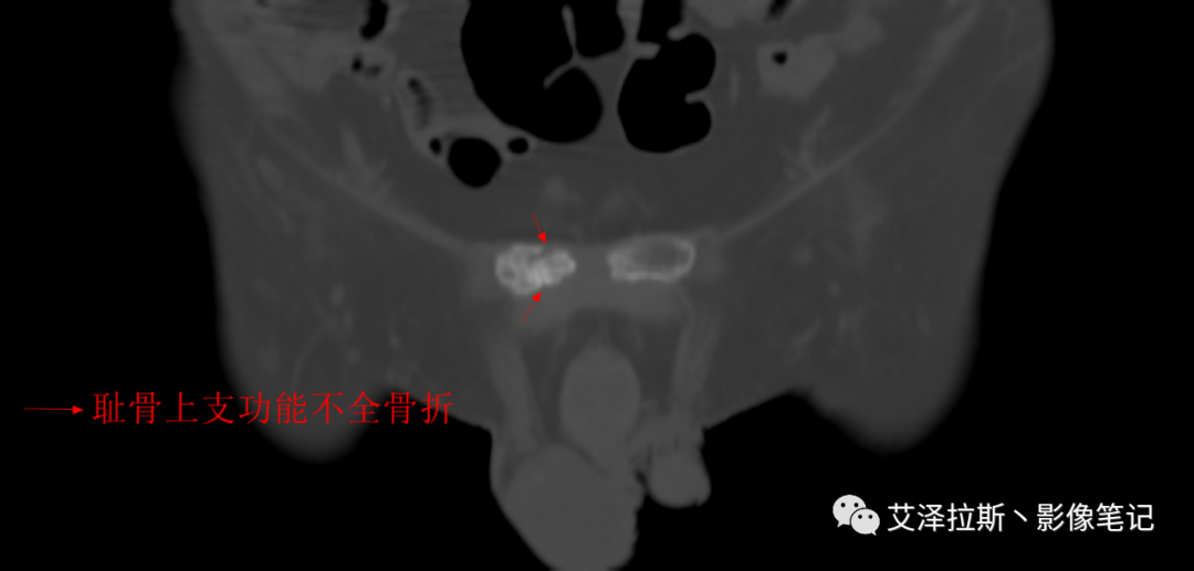 影像PPT - 【病例】骶骨功能不全骨折/衰竭骨折2例X线CT影像-16 影像PPT - 【病例】骶骨功能不全骨折/衰竭骨折2例X线CT影像-16
