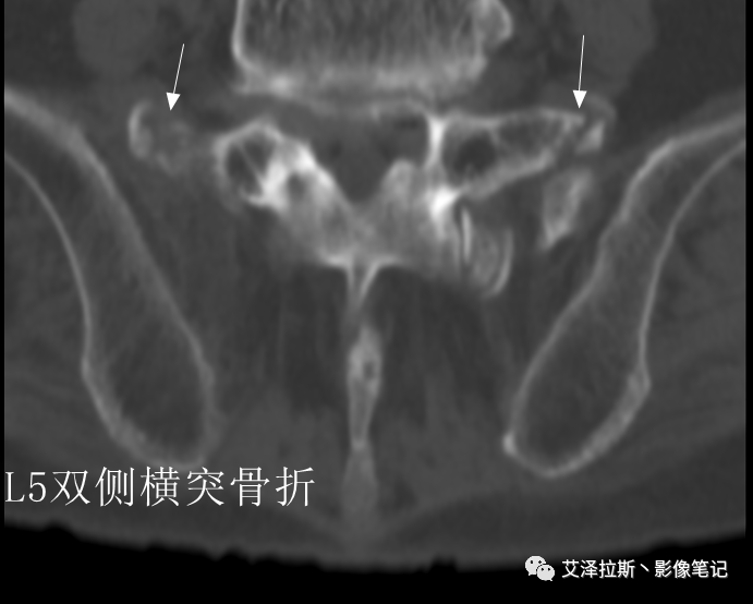 影像PPT - 【病例】骶骨功能不全骨折/衰竭骨折2例X线CT影像-17 影像PPT - 【病例】骶骨功能不全骨折/衰竭骨折2例X线CT影像-17