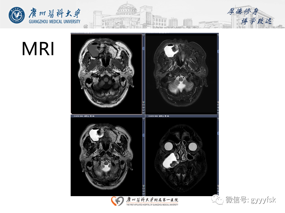 影像PPT - 【病例】成釉细胞瘤 VS 牙源性囊肿-9