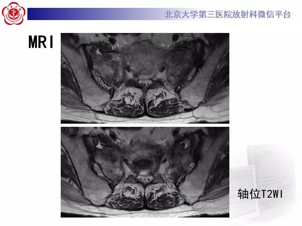 影像PPT - 【PPT】骶骨不全骨折-5
