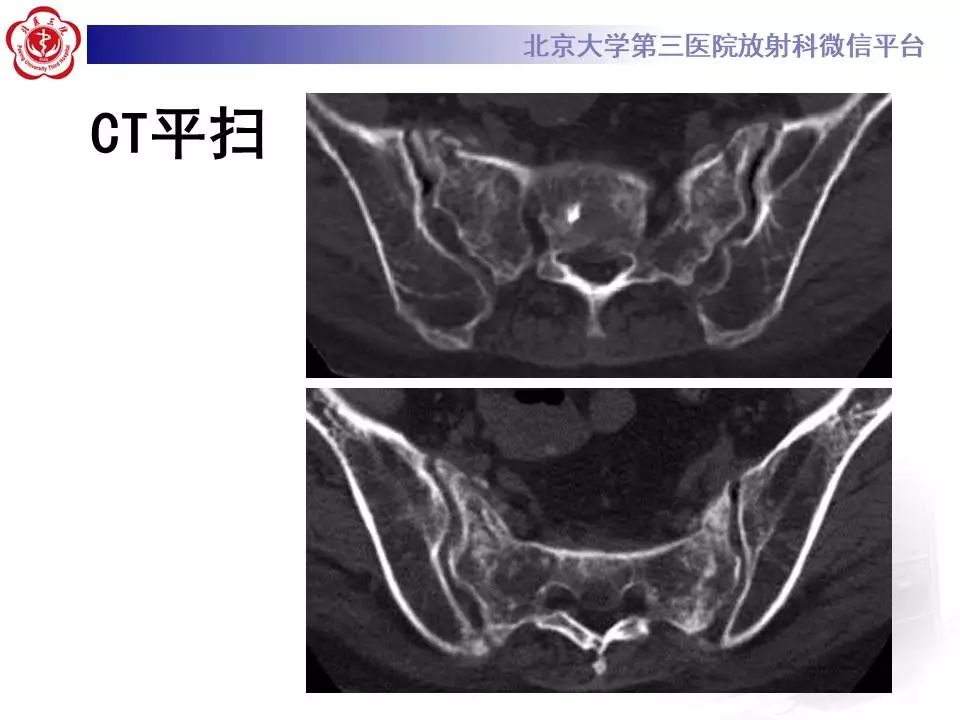 影像PPT - 【PPT】骶骨不全骨折-3