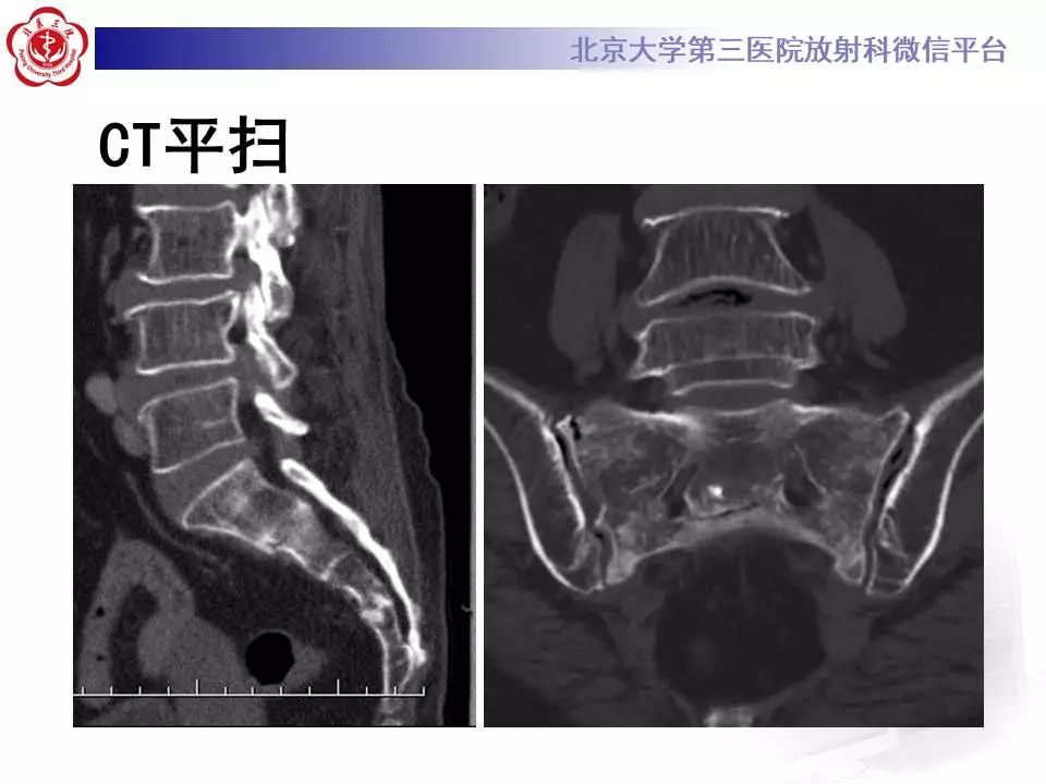 影像PPT - 【PPT】骶骨不全骨折-4