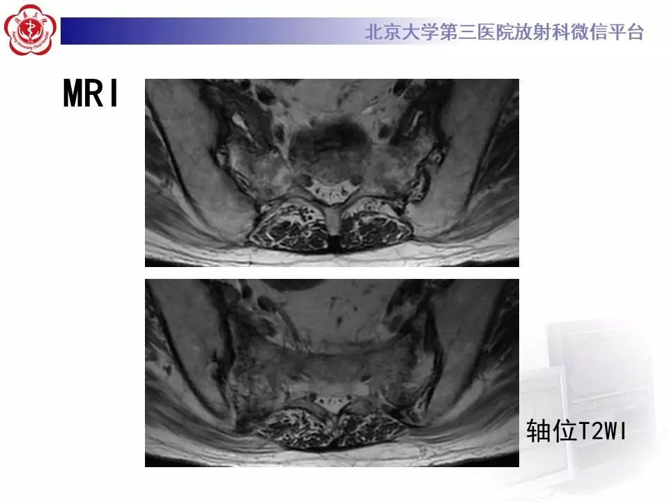 影像PPT - 【PPT】骶骨不全骨折-6