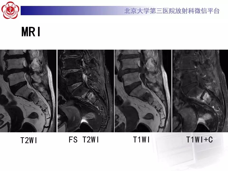 影像PPT - 【PPT】骶骨不全骨折-7