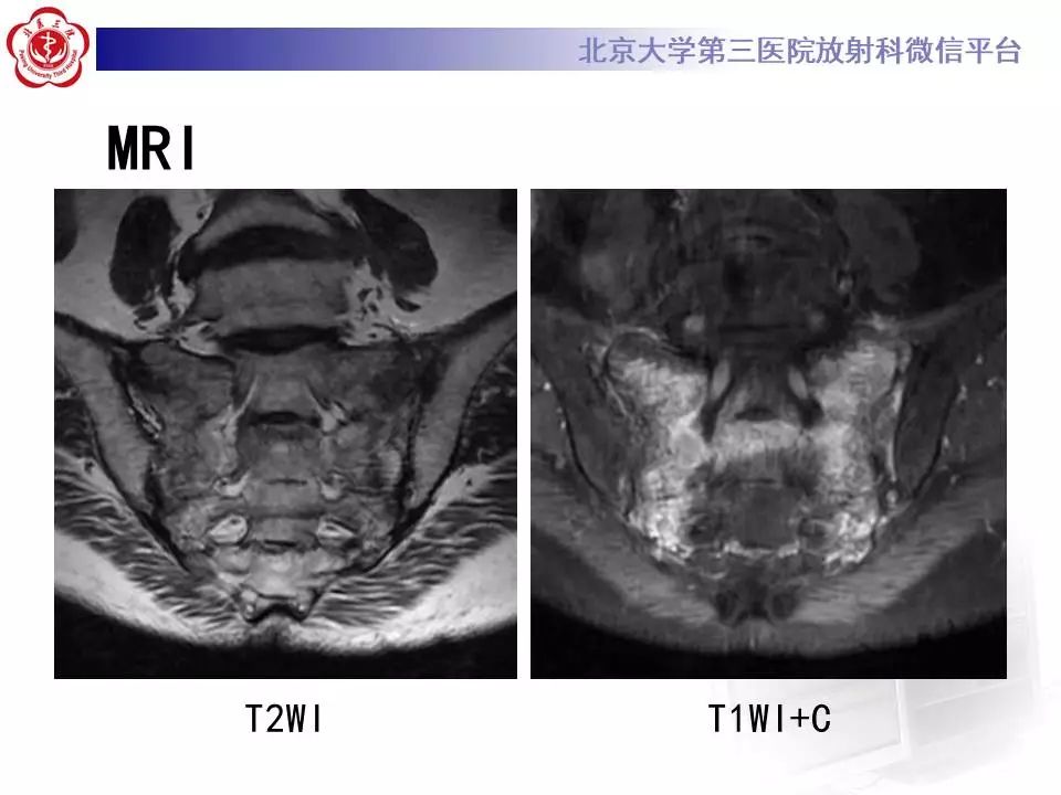 影像PPT - 【PPT】骶骨不全骨折-8
