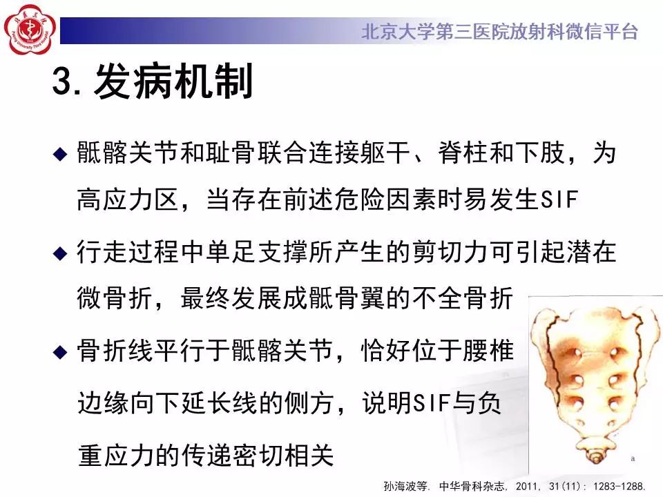 影像PPT - 【PPT】骶骨不全骨折-14