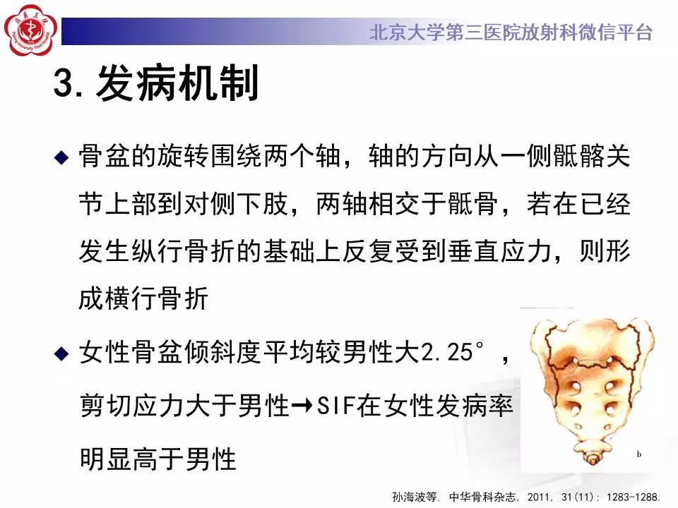 影像PPT - 【PPT】骶骨不全骨折-15