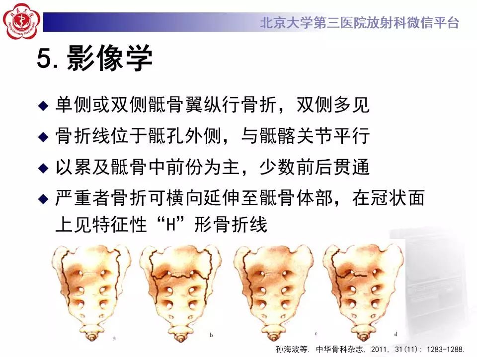 影像PPT - 【PPT】骶骨不全骨折-17