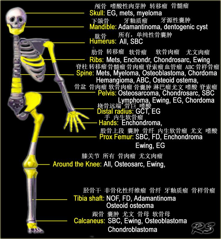 影像PPT - 骨肿瘤鉴别诊断的分析路径-11 影像PPT - 骨肿瘤鉴别诊断的分析路径-11