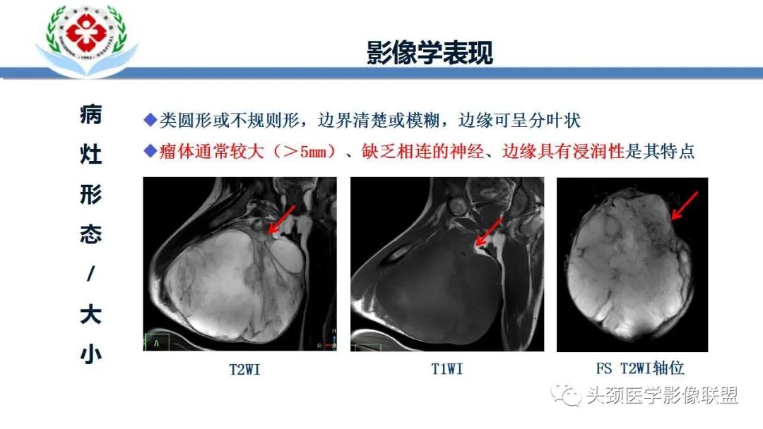 影像PPT - 【PPT】恶性外周神经鞘膜瘤(MPNST)影像学表现与鉴别诊断-5 影像PPT - 【PPT】恶性外周神经鞘膜瘤(MPNST)影像学表现与鉴别诊断-5