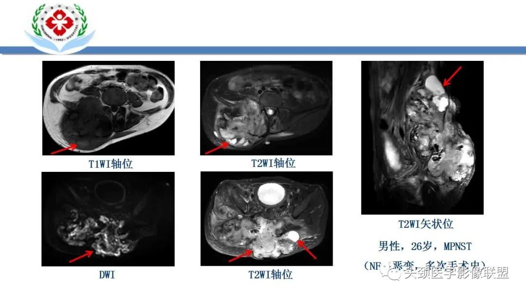 影像PPT - 【PPT】恶性外周神经鞘膜瘤(MPNST)影像学表现与鉴别诊断-7 影像PPT - 【PPT】恶性外周神经鞘膜瘤(MPNST)影像学表现与鉴别诊断-7