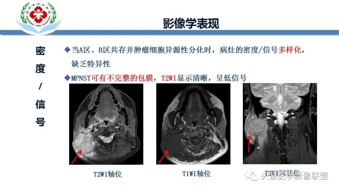影像PPT - 【PPT】恶性外周神经鞘膜瘤(MPNST)影像学表现与鉴别诊断-8 影像PPT - 【PPT】恶性外周神经鞘膜瘤(MPNST)影像学表现与鉴别诊断-8
