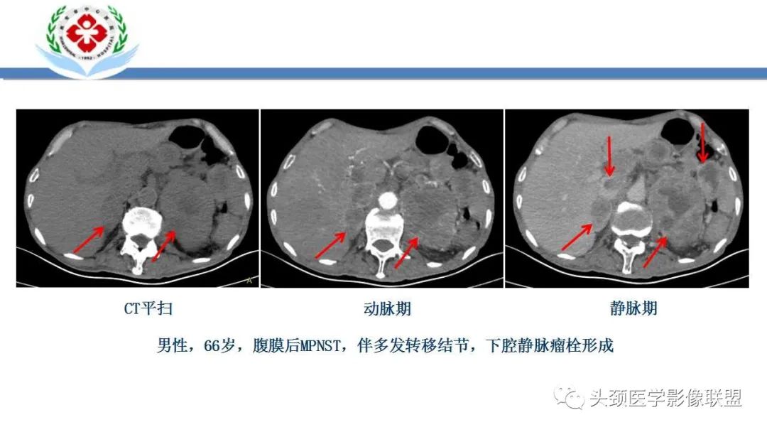 影像PPT - 【PPT】恶性外周神经鞘膜瘤(MPNST)影像学表现与鉴别诊断-10 影像PPT - 【PPT】恶性外周神经鞘膜瘤(MPNST)影像学表现与鉴别诊断-10