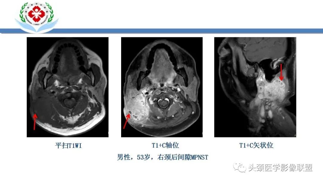 影像PPT - 【PPT】恶性外周神经鞘膜瘤(MPNST)影像学表现与鉴别诊断-11 影像PPT - 【PPT】恶性外周神经鞘膜瘤(MPNST)影像学表现与鉴别诊断-11