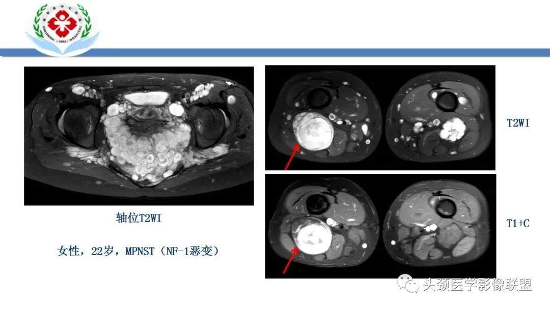 影像PPT - 【PPT】恶性外周神经鞘膜瘤(MPNST)影像学表现与鉴别诊断-14 影像PPT - 【PPT】恶性外周神经鞘膜瘤(MPNST)影像学表现与鉴别诊断-14